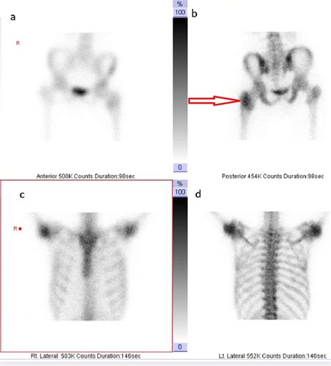 Unlocking Cold Cases: The Role of Bone Isotope Analysis in Forensic Investigations